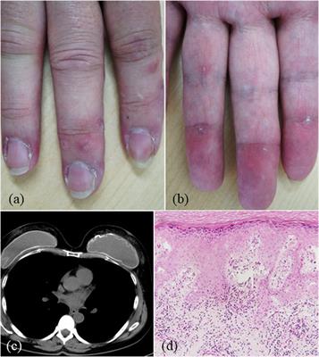 Anti-melanoma differentiation-associated gene 5 antibody-positive clinically amyopathic dermatomyositis in a patient with silicone breast implants